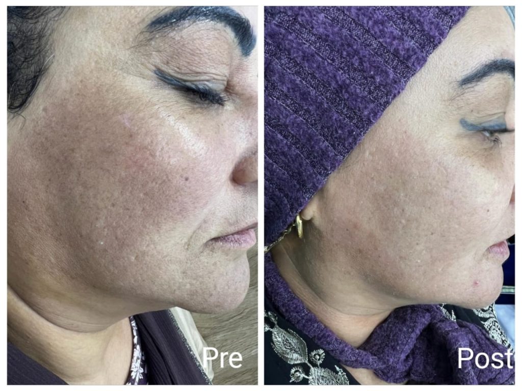 نتائج توحيد لون البشرة